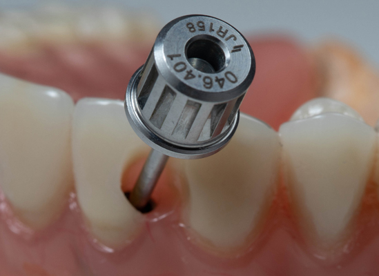 Avoiding Infection With Dental Implants