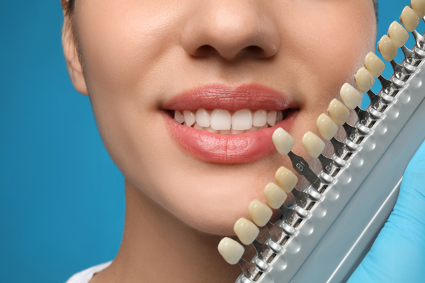 Dental Veneers Are A Solution For Chipped Teeth